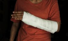 fracture-avant-bras-