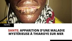 Apparition d’une maladie mystérieuse à Thiaroye sur mer