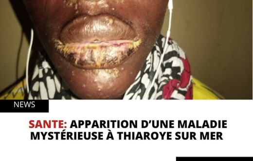 Apparition d’une maladie mystérieuse à Thiaroye sur mer