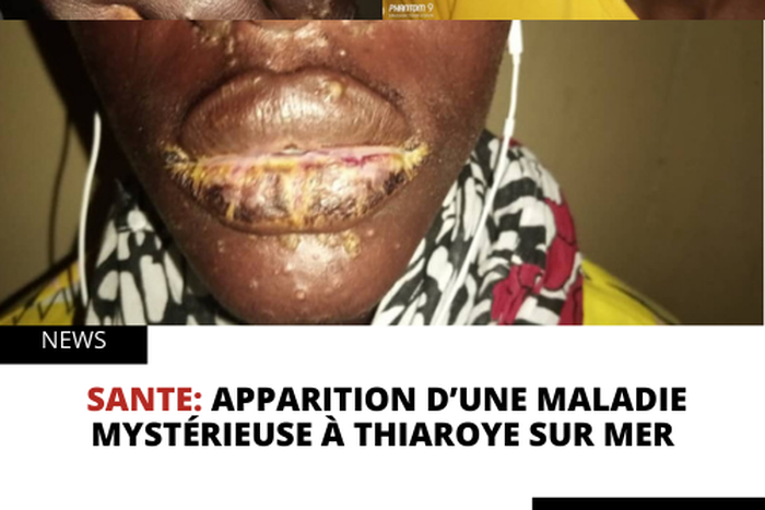 Apparition d’une maladie mystérieuse à Thiaroye sur mer