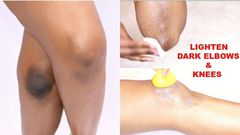 Voici 5 façons de vous débarrasser naturellement des coudes et des genoux sombres