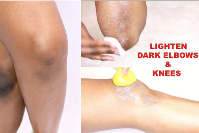 Voici 5 façons de vous débarrasser naturellement des coudes et des genoux sombres
