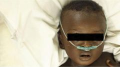 pneumonie-enfant-senegal