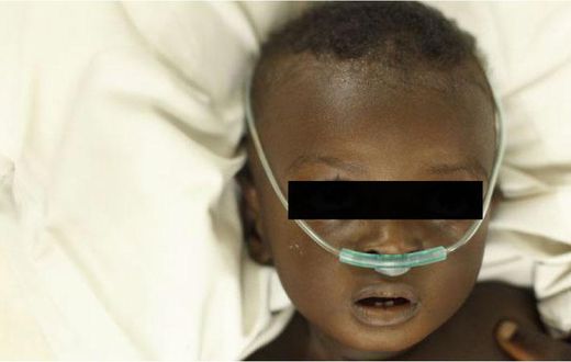 pneumonie-enfant-senegal