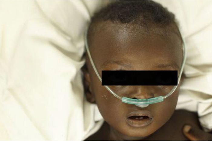 pneumonie-enfant-senegal