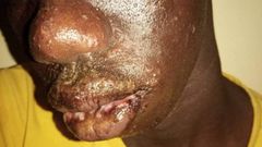 Dermatose  chez les pêcheurs sénégalais