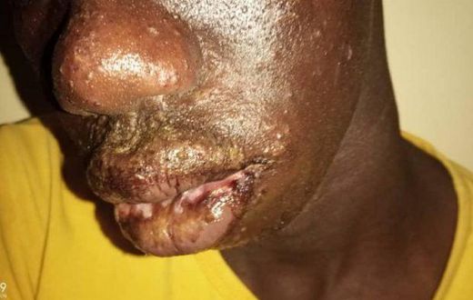 Dermatose  chez les pêcheurs sénégalais