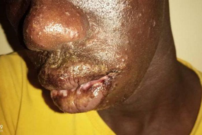 Dermatose  chez les pêcheurs sénégalais