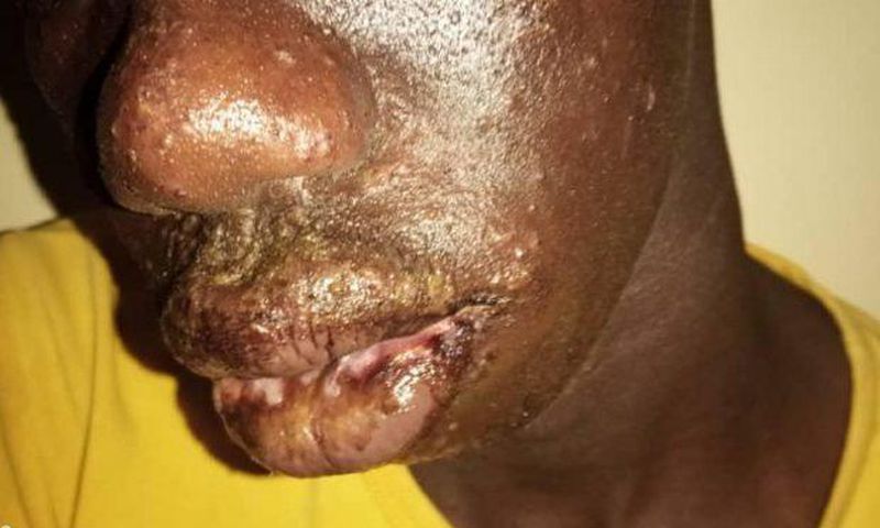Dermatose  chez les pêcheurs sénégalais
