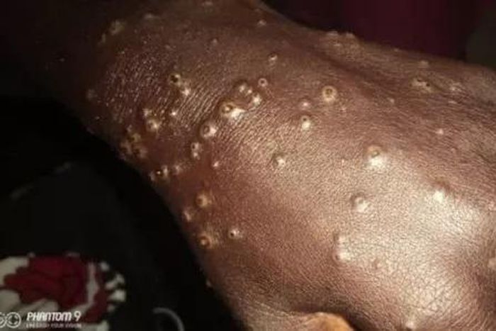 Maladie mystère (1)