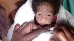 une jeune femme donne naissance à un enfant atteint de progeria
