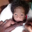 une jeune femme donne naissance à un enfant atteint de progeria