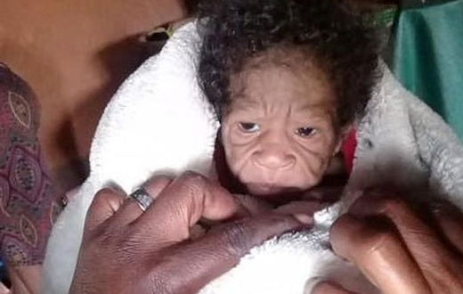une jeune femme donne naissance à un enfant atteint de progeria
