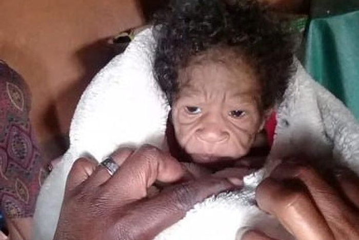 une jeune femme donne naissance à un enfant atteint de progeria