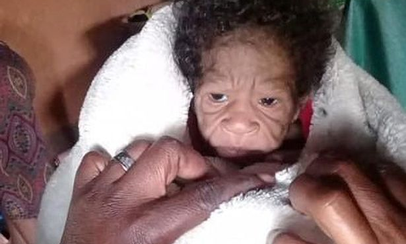 une jeune femme donne naissance à un enfant atteint de progeria