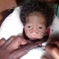 une jeune femme donne naissance à un enfant atteint de progeria