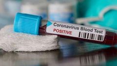 COVID-19 : 130 NOUVEAUX CAS, 137 GUÉRIS ET 49 PATIENTS EN RÉA