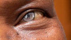 cataracte-cristallin-oeil-operation