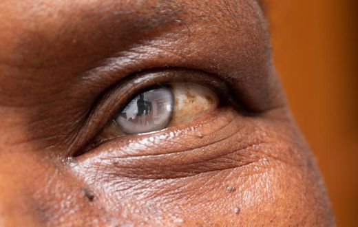 cataracte-cristallin-oeil-operation