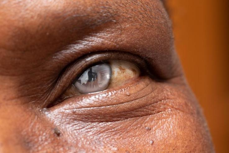 cataracte-cristallin-oeil-operation