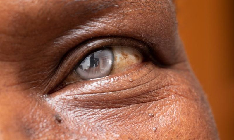 cataracte-cristallin-oeil-operation