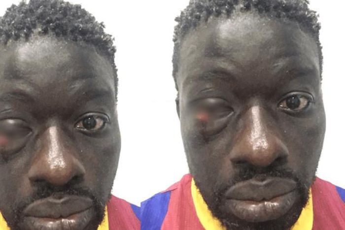 Zoss blessé à l'œil