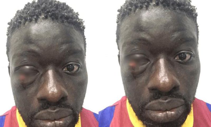 Zoss blessé à l'œil