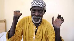 Patient sénégalais qui montre ses mains après avoir reçu un traitement et avoir été guéri de la lèpre - SEYLLOU - AFP
