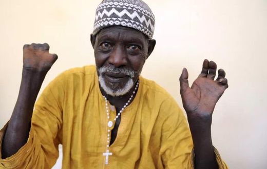 Patient sénégalais qui montre ses mains après avoir reçu un traitement et avoir été guéri de la lèpre - SEYLLOU - AFP