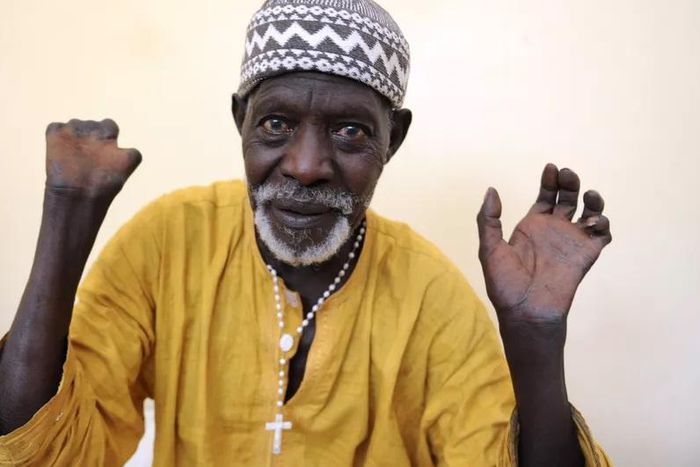 Patient sénégalais qui montre ses mains après avoir reçu un traitement et avoir été guéri de la lèpre - SEYLLOU - AFP