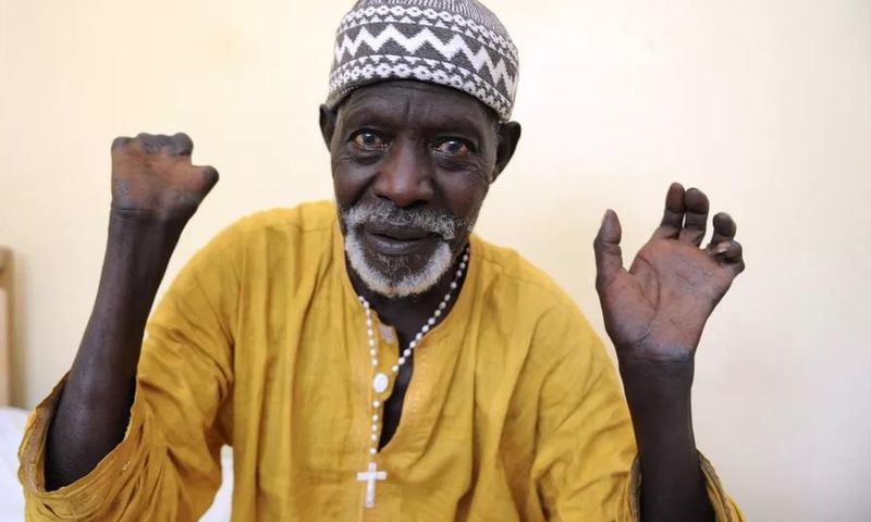 Patient sénégalais qui montre ses mains après avoir reçu un traitement et avoir été guéri de la lèpre - SEYLLOU - AFP