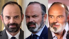 Edouard-Philippe---vitiligo