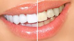 Comment blanchir vos dents avec des écorces de banane