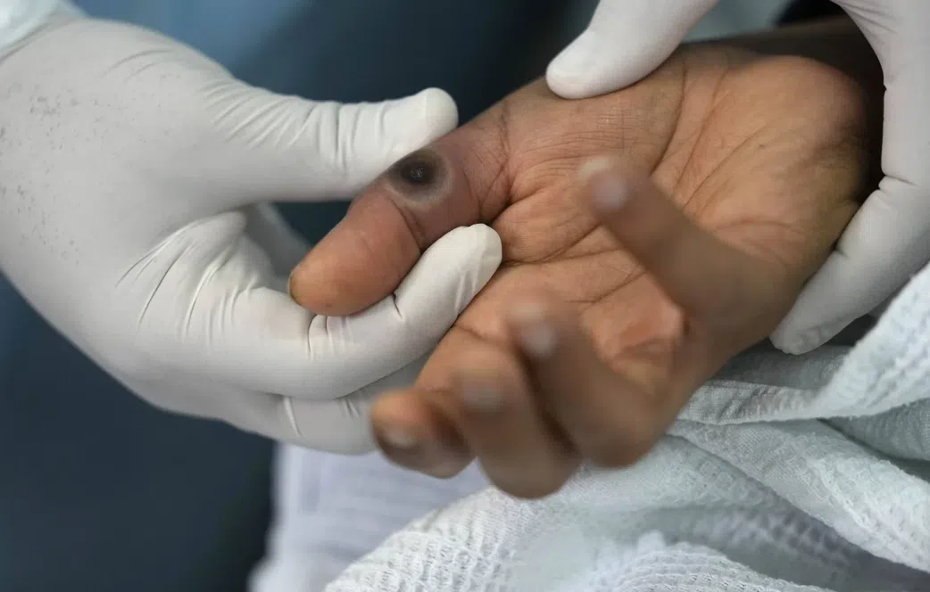 Un cas de variole du singe confirmé en Gambie, 125 cas suspects au Sénégal