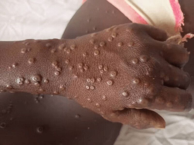 Un cas de variole du singe confirmé en Gambie, 125 cas suspects au Sénégal