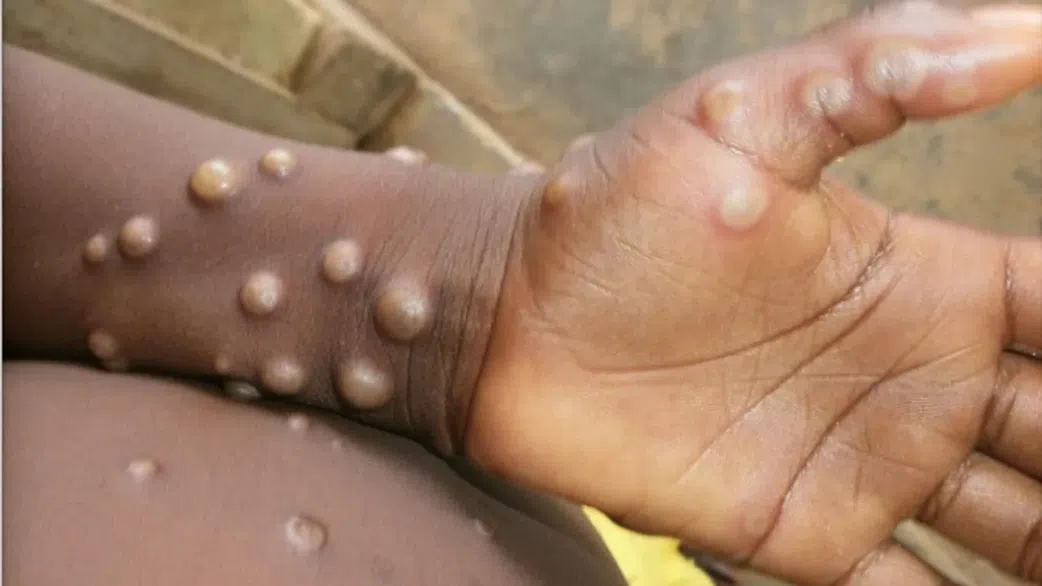 Premier cas de variole du au Sénégal : le pays d'origine du malade connu