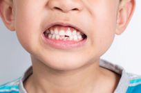 Dents des enfants : Les erreurs qui coûtent cher plus tard !
