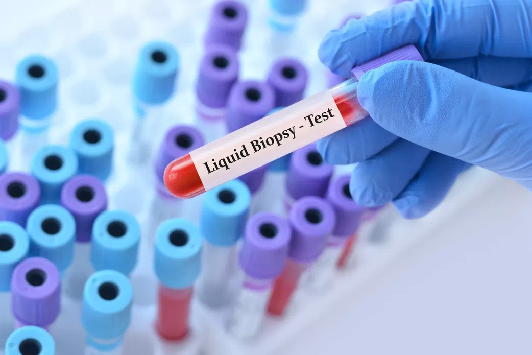 Ce test sanguin pourrait détecter un cancer 10 ans avant !