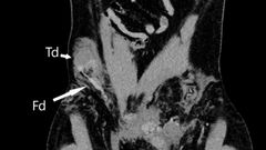 Son testicule remonte dans l’abdomen suite à un accident / BMJ Case Reports 2023
