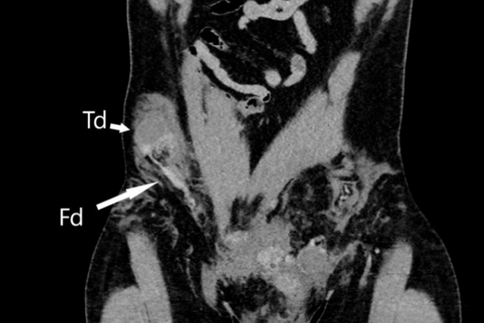 Son testicule remonte dans l’abdomen suite à un accident / BMJ Case Reports 2023