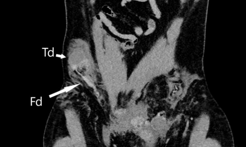 Son testicule remonte dans l’abdomen suite à un accident / BMJ Case Reports 2023