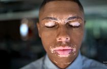 Man with vitiligo