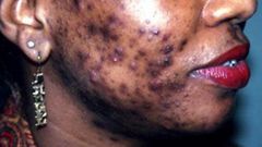 Dépigmentation
