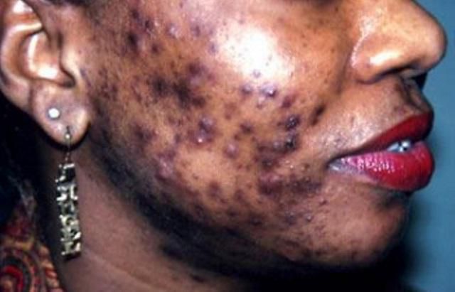 Dépigmentation