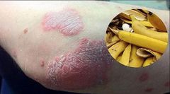 psoriasis