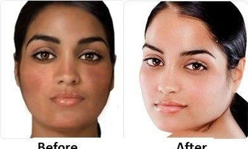 Skin 'bleaching'