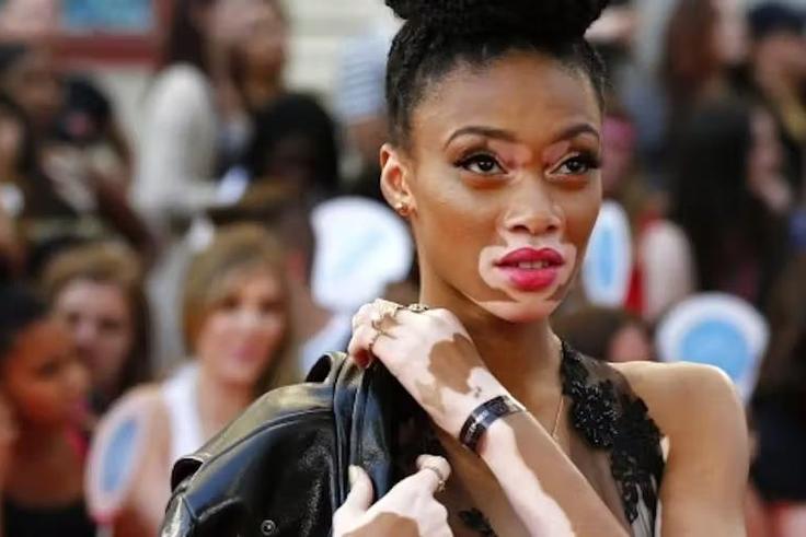 winnie-harlow