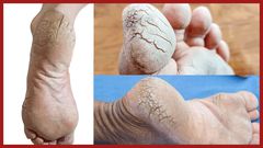 Pieds-craquelés--Photomontage-Pulse