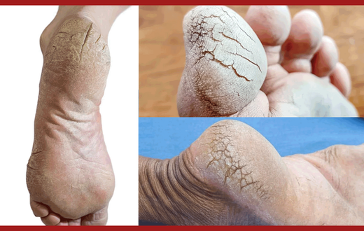 Pieds-craquelés--Photomontage-Pulse