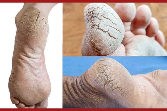 Pieds-craquelés--Photomontage-Pulse